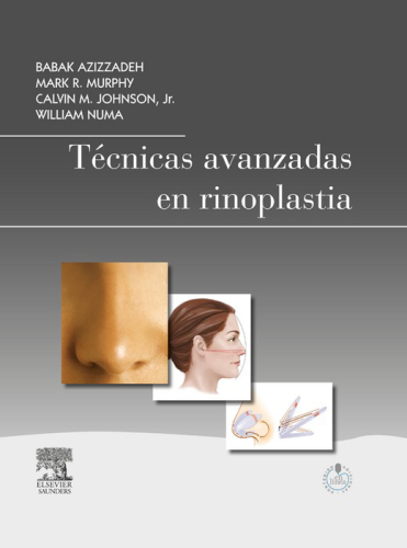 Técnicas avanzadas en rinoplastia