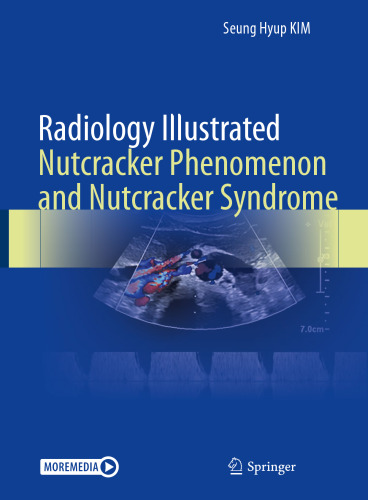 Radiology Illustrated: Nutcracker Phenomenon and Nutcracker Syndrome