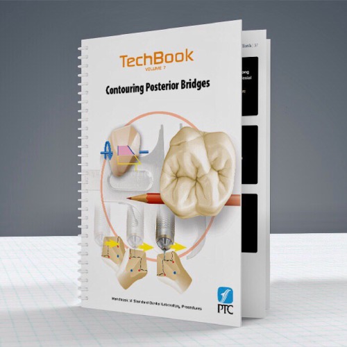 Contouring posterior bridges