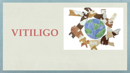 Vitiligo