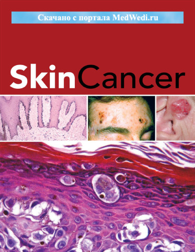 Skin Cancer