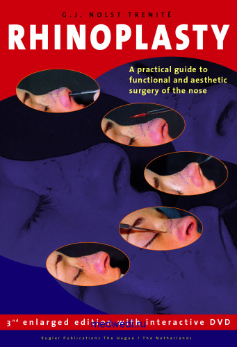 Rhinoplasty